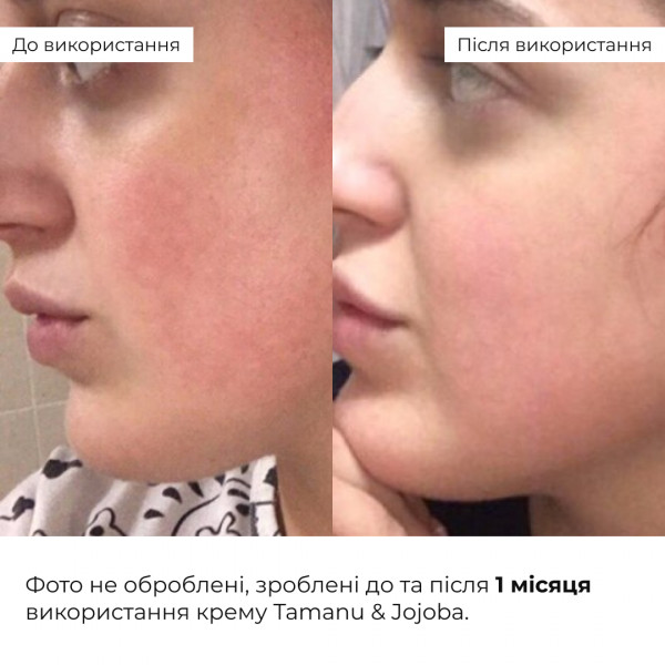 Весенний уход для жирного типа кожи