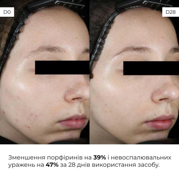 Весенний уход для жирного типа кожи