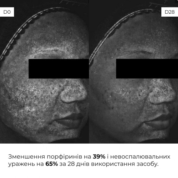 Весенний уход для жирного типа кожи