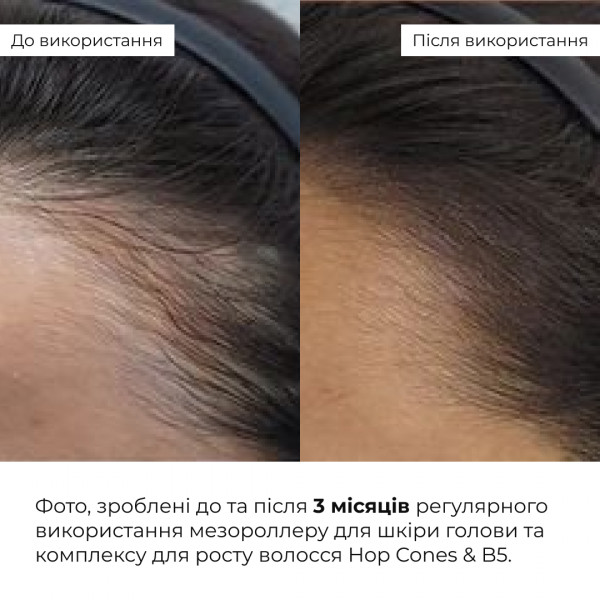Мезороллер для кожи головы + Комплекс для роста волос Hop Cones B5 Hair Growth Invigorating