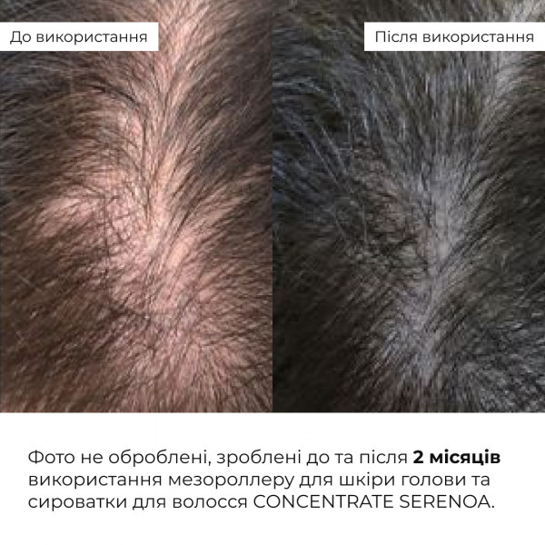 Мезороллер для кожи головы Hillary + Сыворотка для волос CONСENTRATE SERENOA