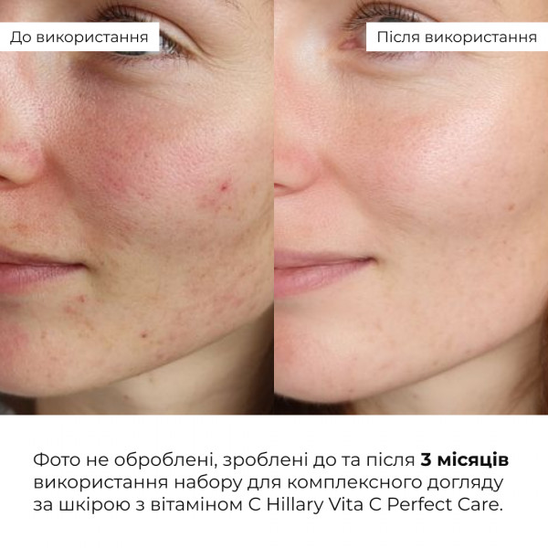 Набор для комплексного ухода за кожей с витамином C Hillary Vitа Perfect Care