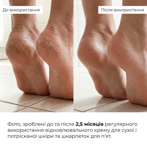Комплекс для заживления трещин и смягчения пяток Hillary Cracked Heel Repair Softening Complex
