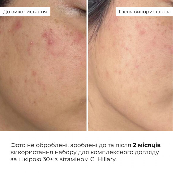 Набор для комплексного ухода за кожей 30+ с витамином С Hillary Vitа С Perfect Care 30+