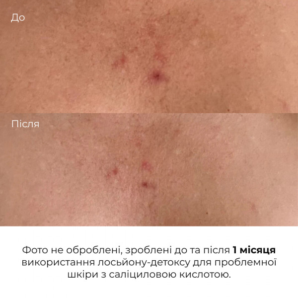 Комплекс для отшелушивания и коррекции сыпи на теле Hillary Exfoliation Body Acne Correction Complex