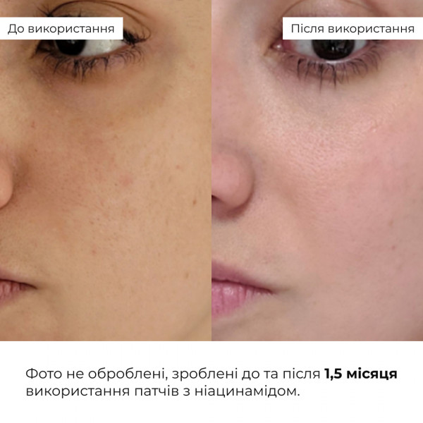 Гидрогелевые патчи с ниацинамидом Hillary Niacinamide Multi Eye Patches, 60 шт.