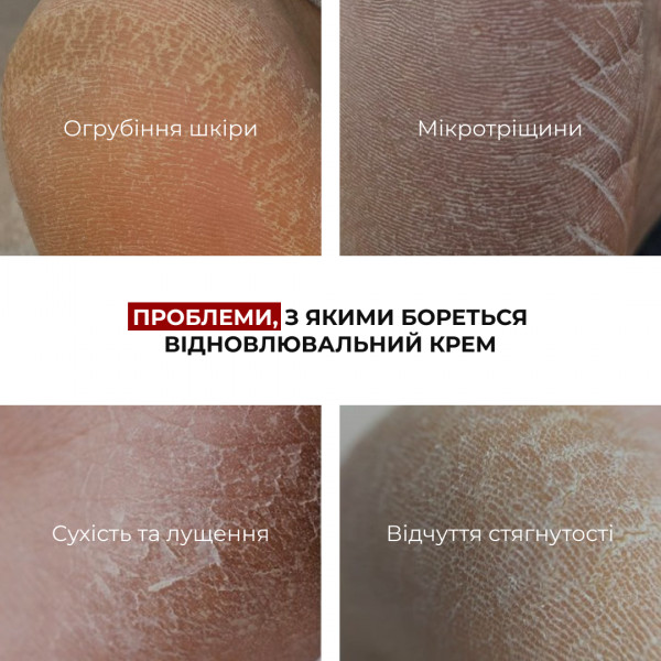 Набор для заживления потрескавшихся пяток Hillary Cracked Heel Repair Set