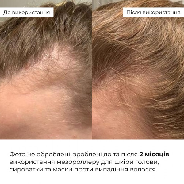 Мезороллер для кожи головы Hillary + Сыворотка и маска против выпадения волос