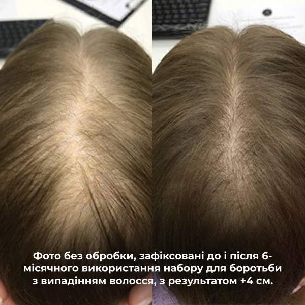 Шампунь + Кондиционер Hillary Serenoa РР Hair Loss Control, 500 мл