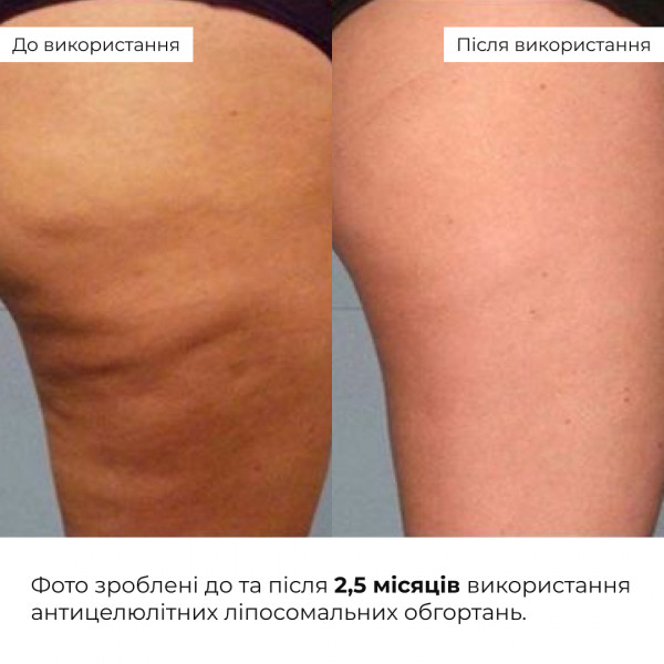 Комплекс антицеллюлитных липосомальных обертываний Hillary Anti-cellulite Bandage LPD'S Slimming (10 уп.)