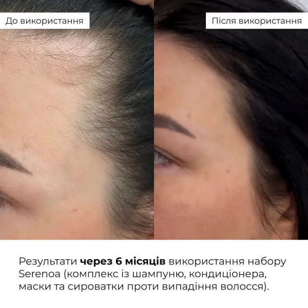 Высококонцентрированный комплекс для волос с экстрактом карликовой пальмы Hillary CONСENTRATE SERENOA, 50 мл