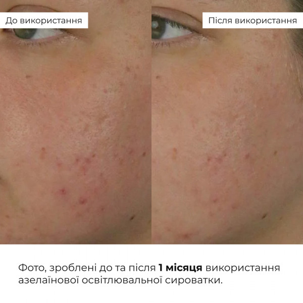 Азелаиновая осветительная сыворотка Hillary Azelight Defense Serum, 30 мл
