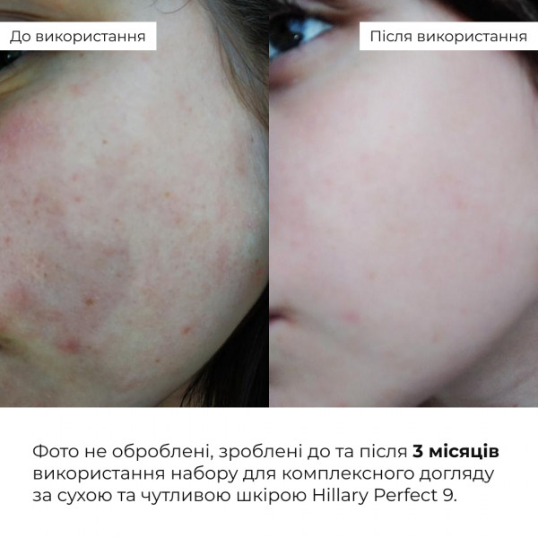 Набор для ухода за сухой и чувствительной кожей Hillary Perfect 9