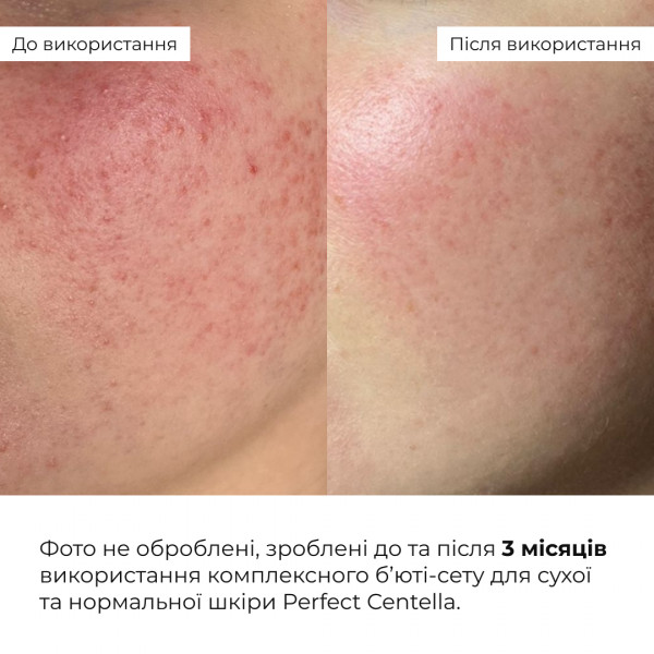 Набор с центеллой для сухой и нормальной кожи Hillary Perfect Centella Deep Hydration