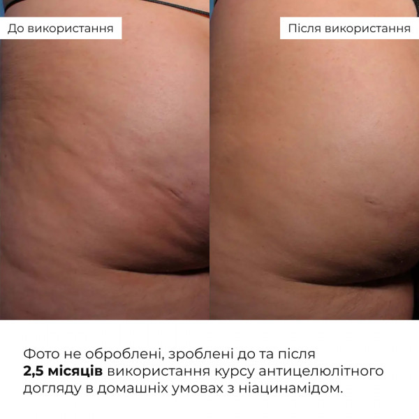 Курс антицеллюлитного ухода в домашних условиях с ниацинамидом Hillary Niacinamide Anti-Cellulite Home Care