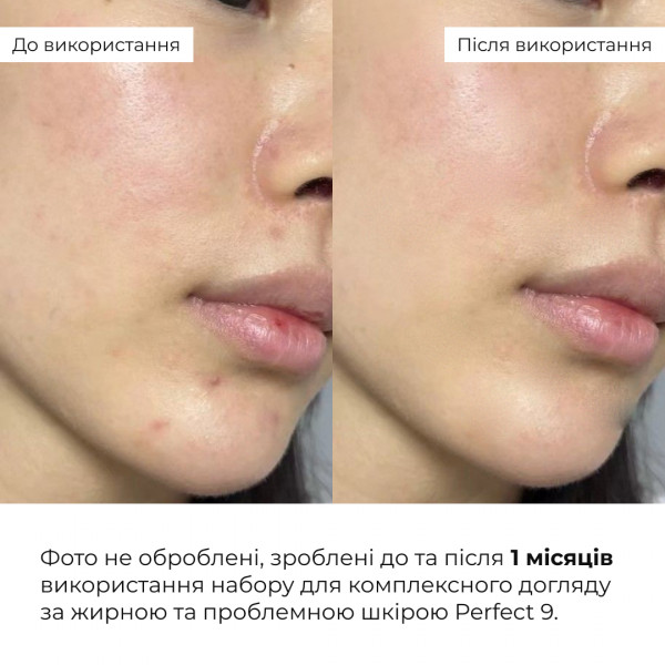 Набор для комплексного ухода за жирной и проблемной кожей Hillary Perfect 9
