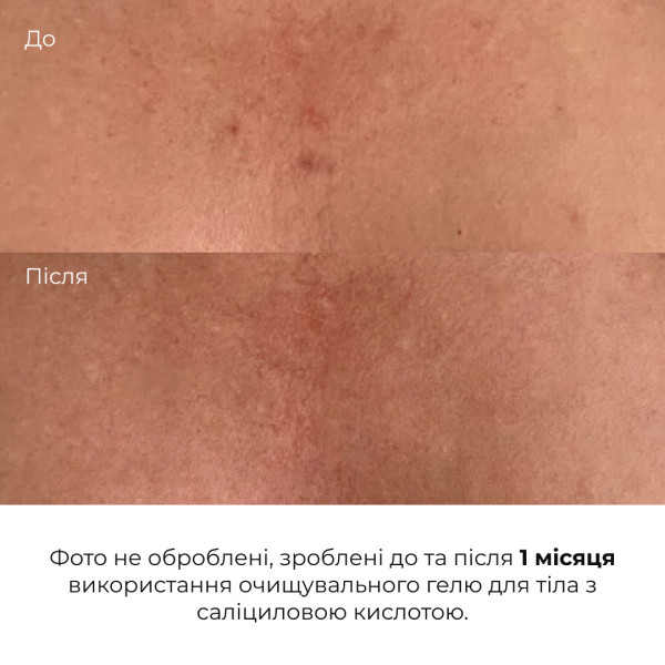 Очищающий гель для тела с салициловой кислотой Hillary Anti-Acne Salicylic Body Wash, 200 мл