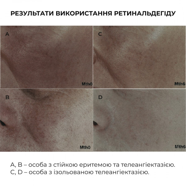 Ночная интенсивная сыворотка с ретиналем Hillary Night Intense Retinal Serum, 30 мл
