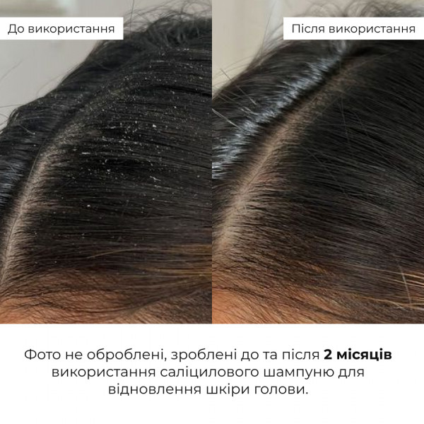 Комплекс для жирної шкіри голови та відновлення пошкодженого волосся HiLLARY
