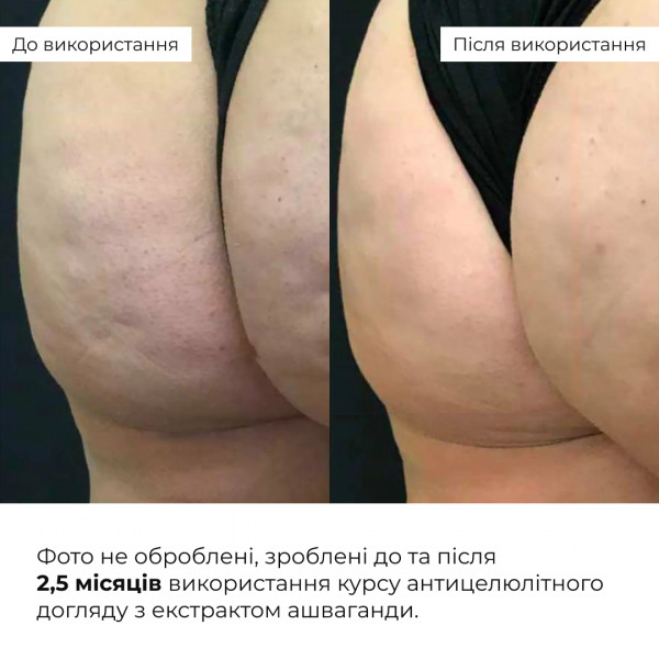 Курс антицеллюлитного ухода в домашних условиях с экстрактом ашваганды Hillary Ashwagandha Anti-Cellulite Care