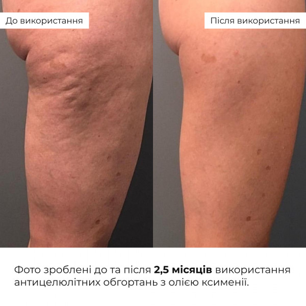 Антицеллюлитные обертывания с маслом ксимении Hillary Anti-cellulite Bandage African Ximenia