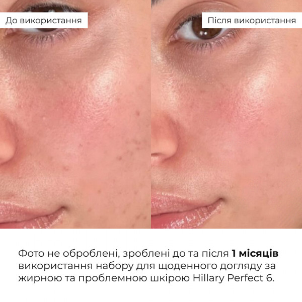 Набор для ежедневного ухода за жирной и проблемной кожей Hillary Perfect 6