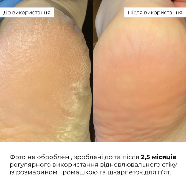 Набор для заживления и мягкости пяток Hillary HydraHeel Repair Relief Set