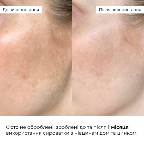 Комплекс антивікового догляду для контролю жирності та зменшення ознак втоми HiLLARY