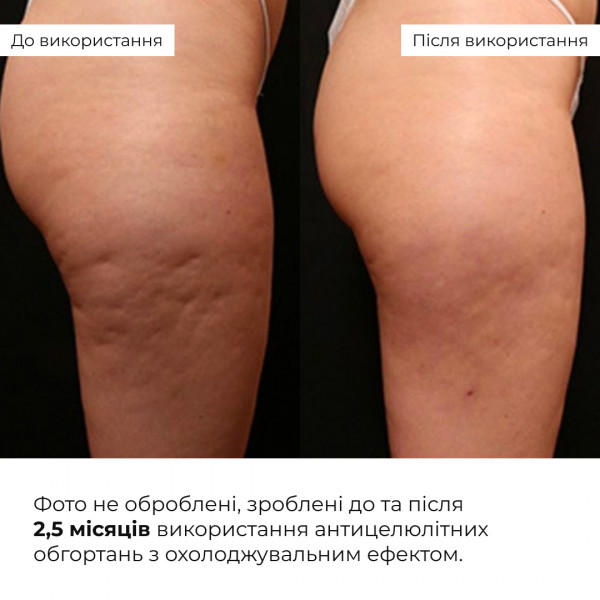Набор охлаждающих обертываний Hillary Cooling Anti-Cellulite Wrap Set