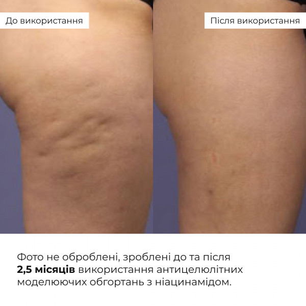 Набор охлаждающих обертываний Hillary Cooling Anti-Cellulite Wrap Set