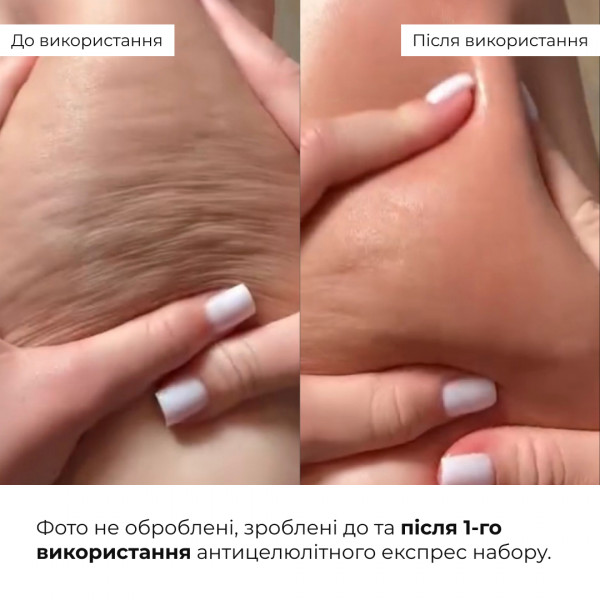 Антицеллюлитный экспресс набор Hillary Anti-Cellulite EXPRESS Sculpt Set