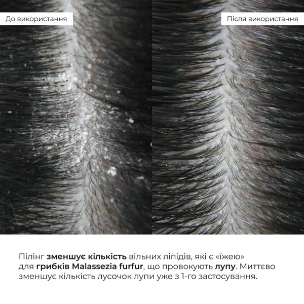 Энзимный пилинг для кожи головы + Набор для сухого типа волос Hillary Aloe Deep Moisturizing