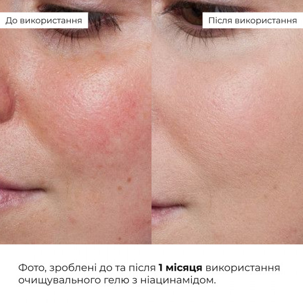 Комплекс щоденного догляду для жирної та комбінованої шкіри Hillary Daily Care Complex for Oily & Combination Skin