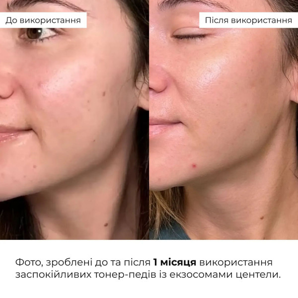 Комплекс для двухуровневого обновления и успокоения кожи Hillary Dual-Level Renewal Soothing Complex