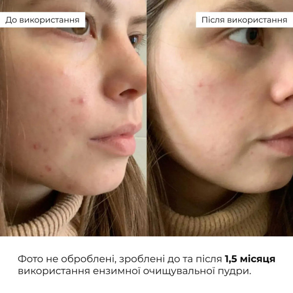 Набор для глубокой очистки и себоконтроля кожи Hillary Deep Cleansing Sebum Control Set