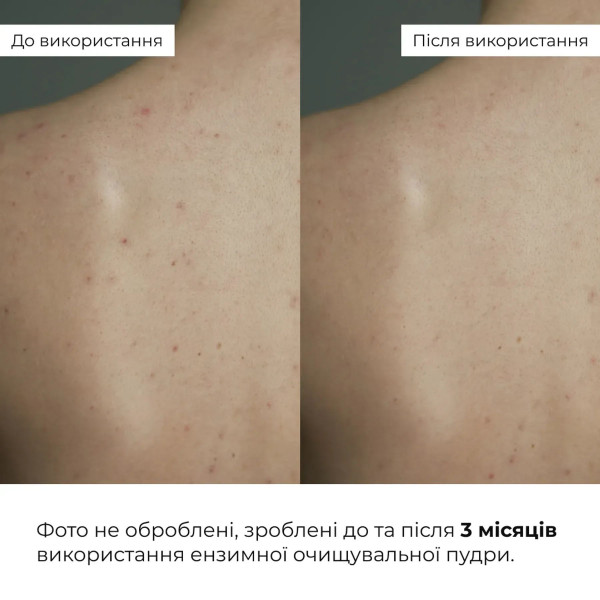 Набор для глубокой очистки и себоконтроля кожи Hillary Deep Cleansing Sebum Control Set