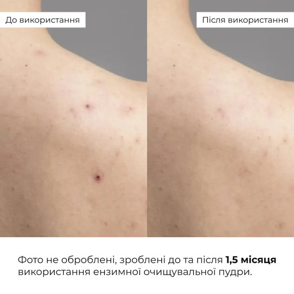 Набор для глубокой очистки и снятия отеков Hillary Enzyme Cleanse Anti-Puffiness Complex