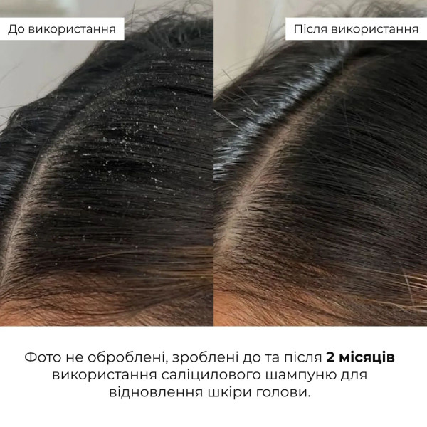 Набор для восстановления волос и кожи головы с салициловой кислотой Hillary Salicylic Hair Scalp Restoration Set