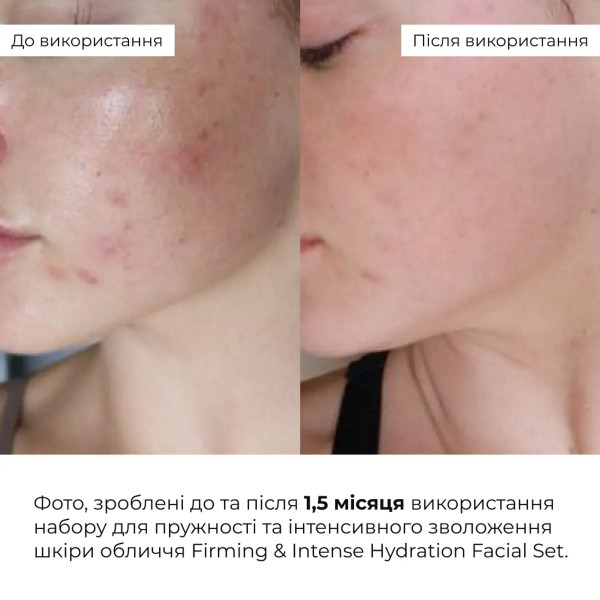 Набор для уменьшения отеков и глубокого увлажнения кожи лица Hillary Puffiness Deep Hydration Facial Set