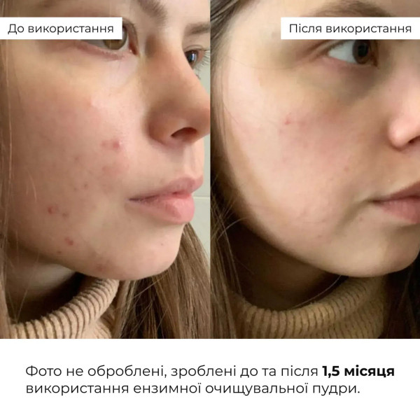 Набор себорегулирующего ухода для жирной и проблемной кожи лица Hillary for oily and problematic skin